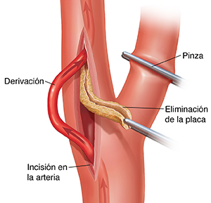 Resultados a largo plazo de pacientes sintomáticos y asintomáticos sometidos a endarterectomía carotídea en un hospital comunitario de volumen medio