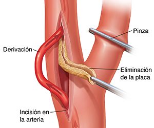 Resultados a largo plazo de pacientes sintomáticos y asintomáticos sometidos a endarterectomía carotídea en un hospital comunitario de volumen medio
