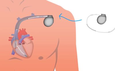 Proceso de implante de un DAI Subcutáneo (S-ICD)￼